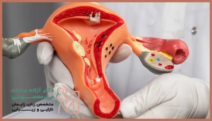 جراحی میومکتومی برای چه کسانی مناسب است؟