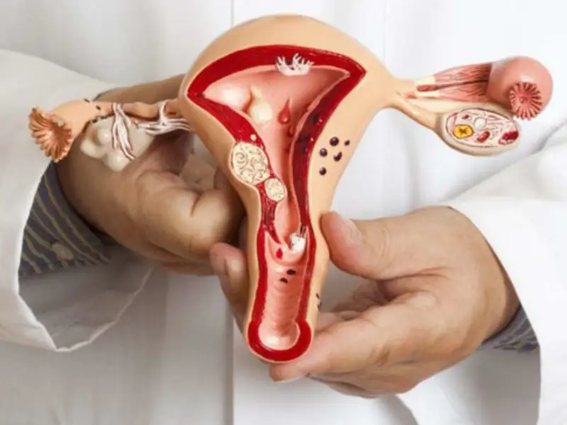 جراحی میومکتومی در اصفهان