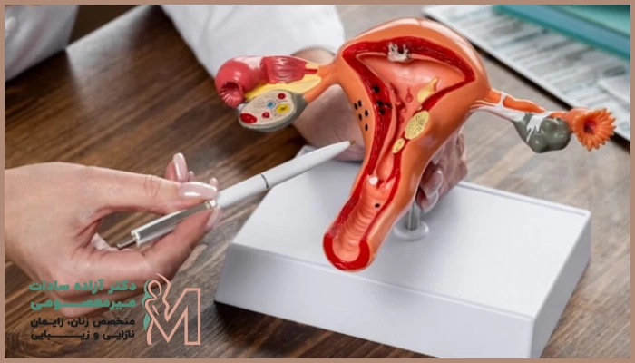 جراحی هیسترکتومی را چه زمانی انجام می‌دهند؟ 