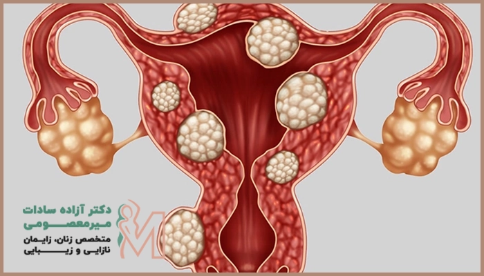 علائم بیمای اندومتریوز