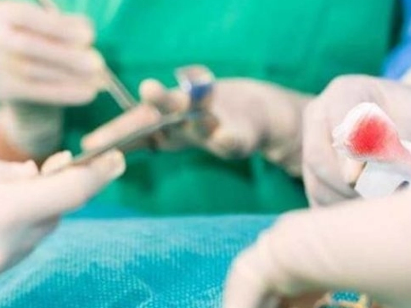 مراقبت‌های بعد از کرایوتراپی زگیل تناسلی